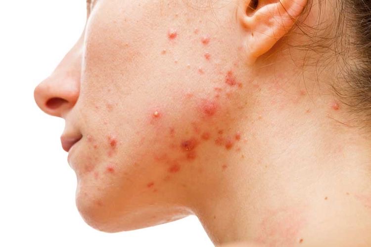 Acne Treatment
