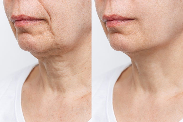 Face Lift Treatment ( for sagging skin )