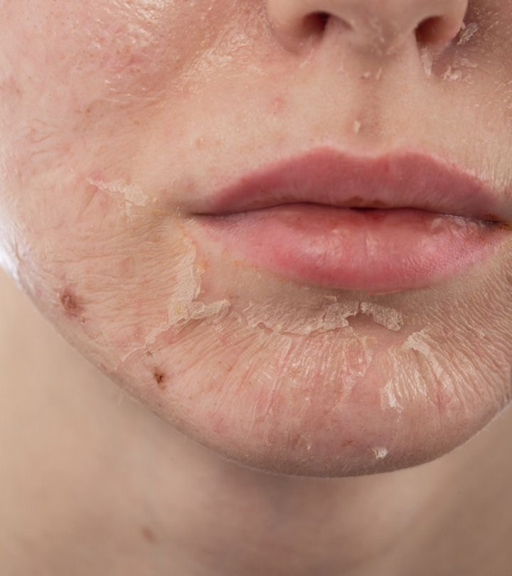 IPL Peel Treatment