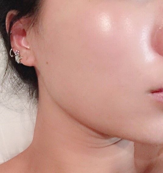 Whitening Treatment